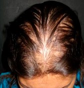 Psoriasis