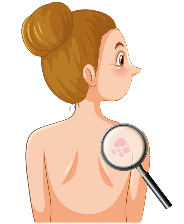 Psoriasis