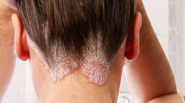 Psoriasis